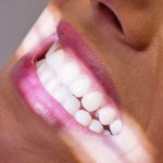 Blanqueamiento Dental Madrid Opiniones