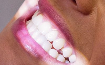 Procedimiento de Blanqueamiento Dental y sus Beneficios