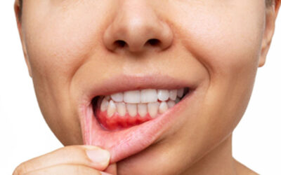 Cambios de la Salud Oral Durante el Embarazo