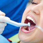 Limpieza Dental Madrid Precio